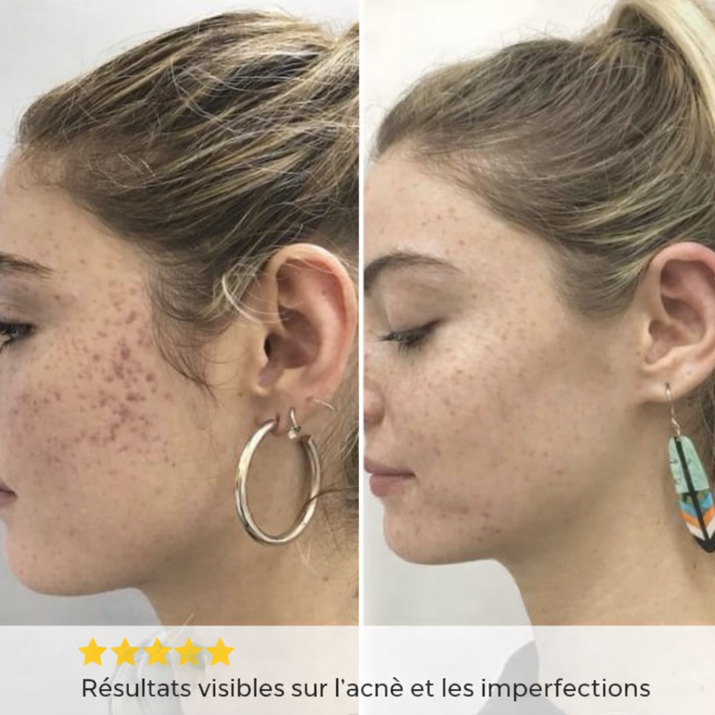 Purito Antiacné Corps et Visage Purskin™